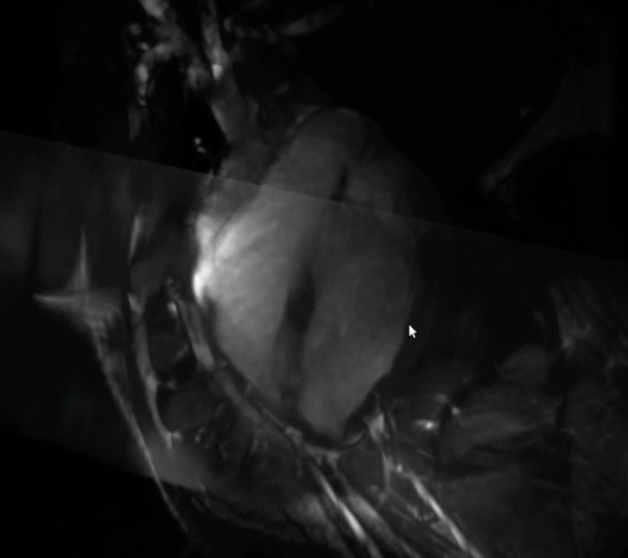 4D Heart Visualisation